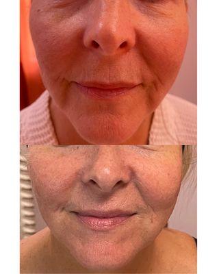 3 Advanced Plasma Treatments, 2 Age Defying Facials