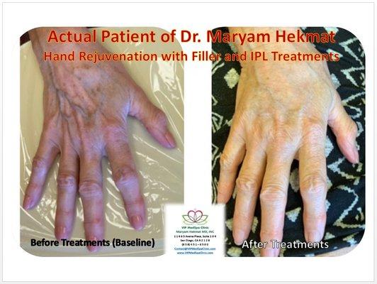 Hand Rejuvenation