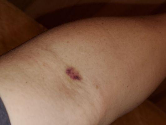 Didn't feel too bad at the time when they drew blood yesterday, but they gave me a big bruise...