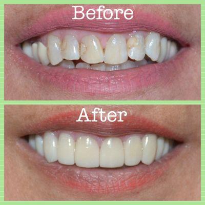 Cosmetic porcelain emax Veneers and Crowns, smile makeover!