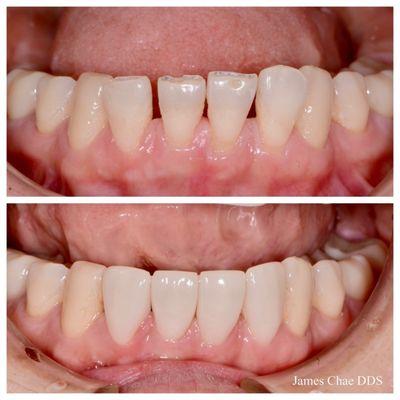 Emax crowns to close the gaps and to straighten the worn teeth.