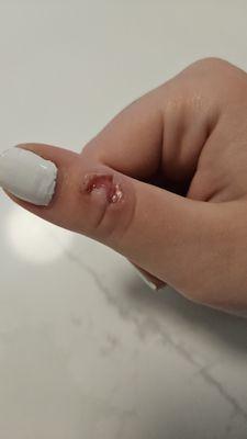 My daughter's thumb 7 days AFTER Dr. Wallach froze off her wart. It was twice this size originally. She told me every day how much it hurt.