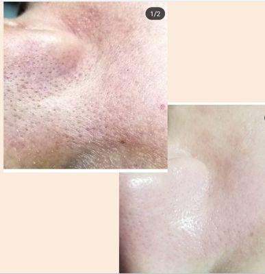 Before and after deep pore cleansing