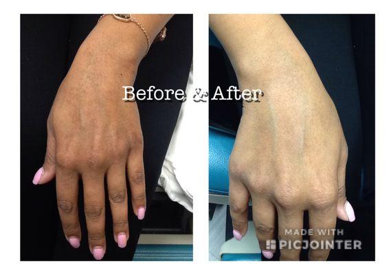 Before & After: Glutathione Skin Lightening