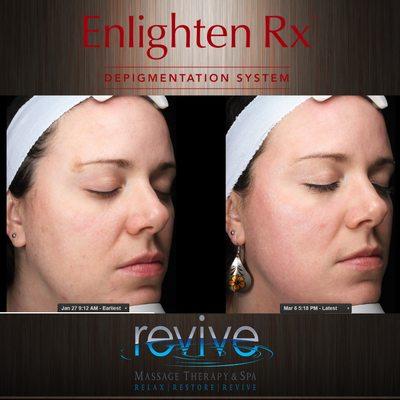 Enlighten Treatment to reduce pigmentation/sun damage.