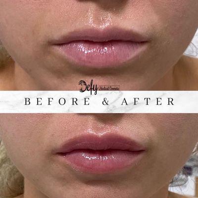 Another beautiful lip filler job by Dr. Quach.