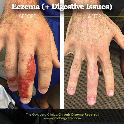 Eczema Before and After