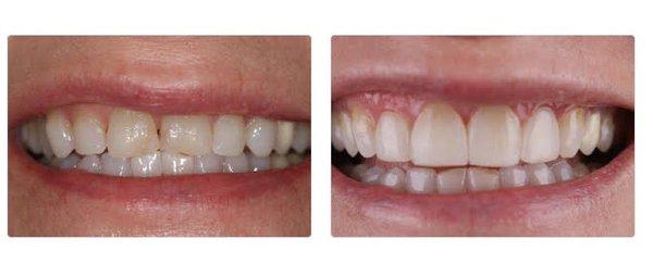 Before and after Composite Veneers.