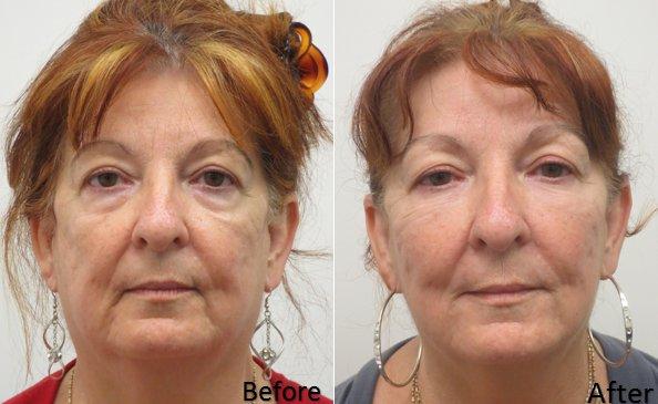 Liquid Face Lift