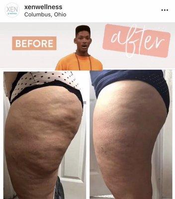 Cellulite treatment! CryoToning!