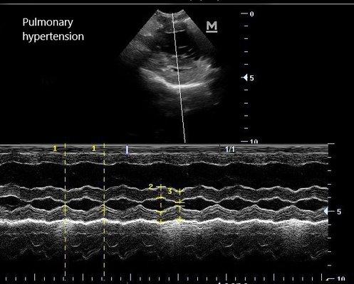 Heart issues can also be detected with ultrasound. 
Case of pulmonary hypertension.