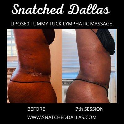 Abdominoplasty Lymphatic Massage