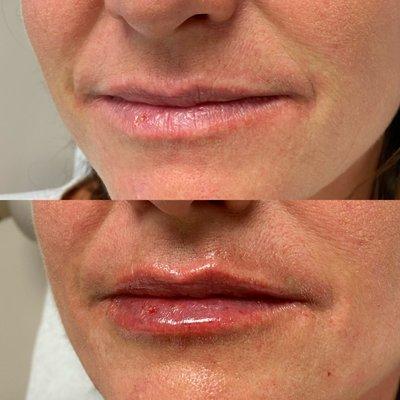 Before after lip filler