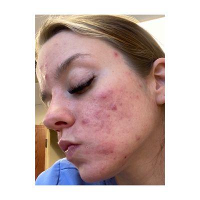 Cystic acne: month 1 treatment