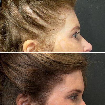 Hair restoration injections before and after