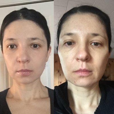 Before (left) age 40 - no fillers no botox. After - gelber deformed my face with 7 syringes of filler. She said filler, she never showed.