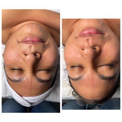 Customized Facial