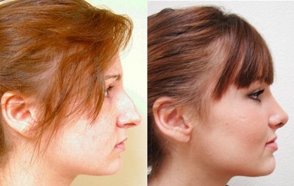 Rhinoplasty with Dr. Kimberly Henry