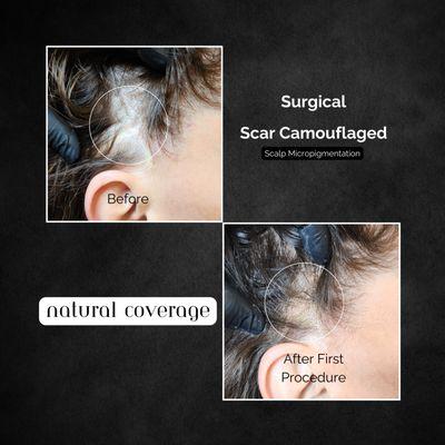 Scalp Micropigmentation Scar Camouflage