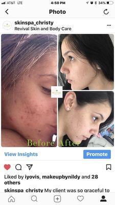 This picture shows before and after removal of grade 3-4 acne is finally under control. First picture only shows half way through treatment.