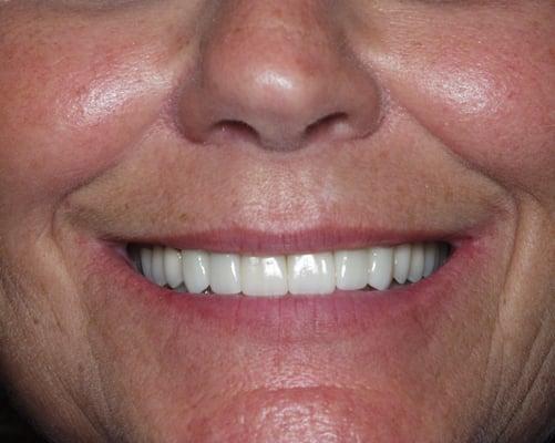 Full upper veneers by Dr. Elan Salee.