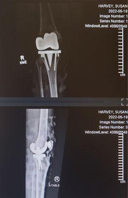 He used the Natural Zimmer persona knee replacement for me, i It allows the bones to grow into it and become part of your leg.