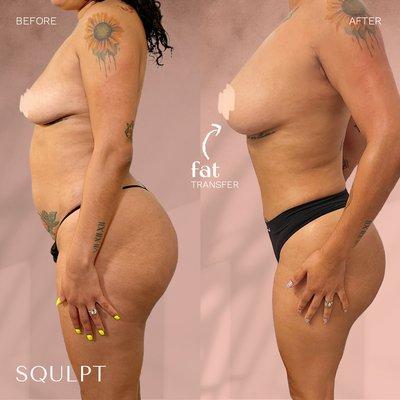 Fat Transfer to Breasts (875 cc/right, 775 cc/left) + SoftSqulpt™ awake lipo to abdomen, waist & hips, lower back, back bra roll