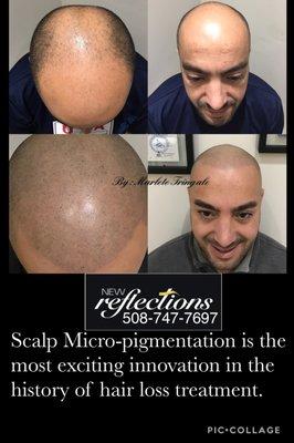 Scalp Micropigmentation