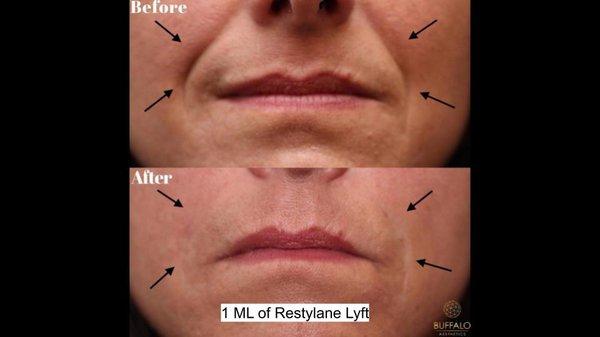 Filler to Nasolabial Folds and Marionette Lines