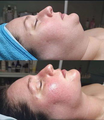 The Magic Touch facial with added microdermabrasion