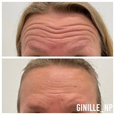 Botox to soften forehead lines