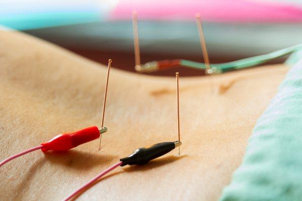 Electrical Stimulation on acupuncture points for low back pain