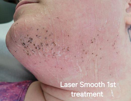 Immediately after 1st treatment.  Facial laser hair removal, normal redness to the skin & immediate reaction of the hair to Laser treatment!