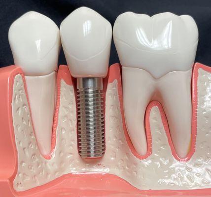 Use dental implants to replace missing teeth. Our 3-D imaging technology enables us to place implants with precision.