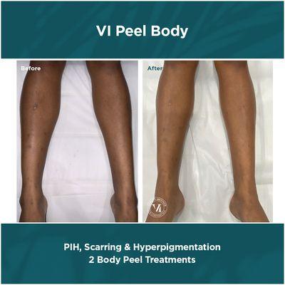 VI PEEL 

Body