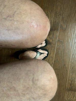 It's the left knee. This photo was taken 6 weeks after the surgery. It looks even better now.