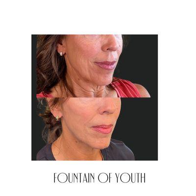 The Fountain of Youth treatment