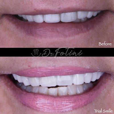 Trial smile by Dr Chrisopoulos to show our patient  how her new smile makeover will look.