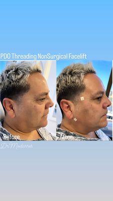 PDO Threading Jawline and double chin correction