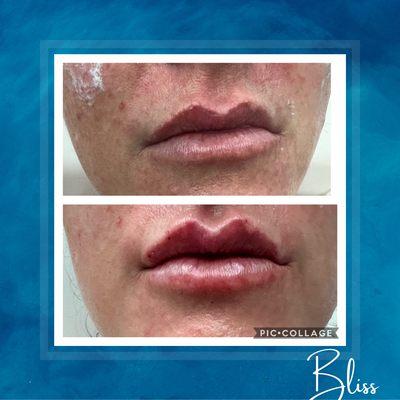 Lip Augmentation