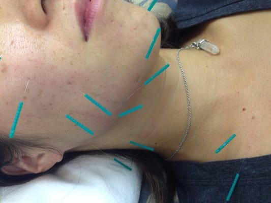 We offer acupuncture for facial rejuvenation and tight neck line also.