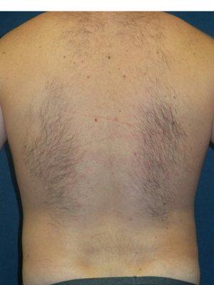 Male, 36 yr old AFTER LIPOSUCTION FLANKS