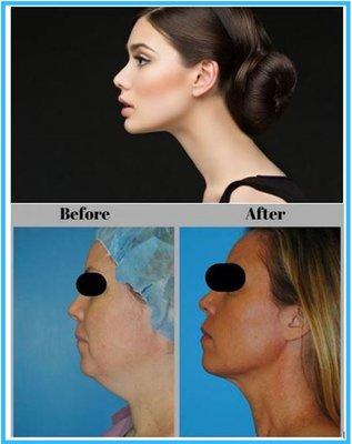 You will be amazed at what a little procedure can do!  Try the Natural Lift with it's pioneer: Dr, Sharon Giese in NYC!