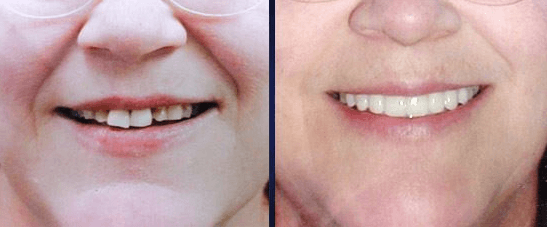 Ask about our Trial Smile, and find out how you can start to transform your smile in one visit!