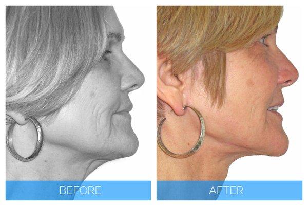 miniLift Facelift patient Before & After