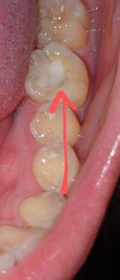 Evidence of a root canaled molar drilled by him which was fixed by another dentist.