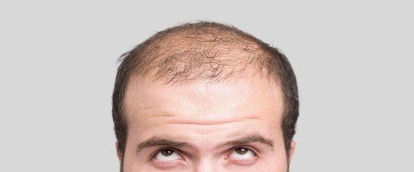 Hair Loss? We can help you - give us a call.