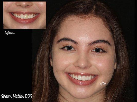 Veneers by Dr Shawn Matian