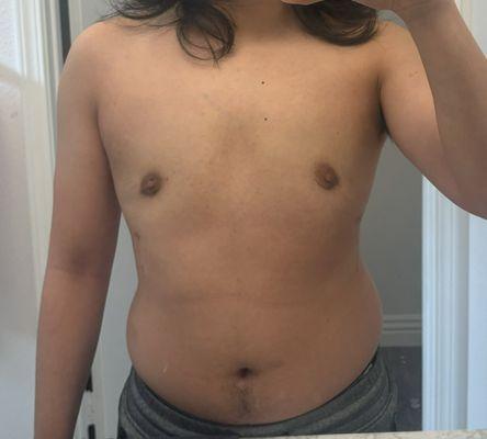 3 months post-procedure