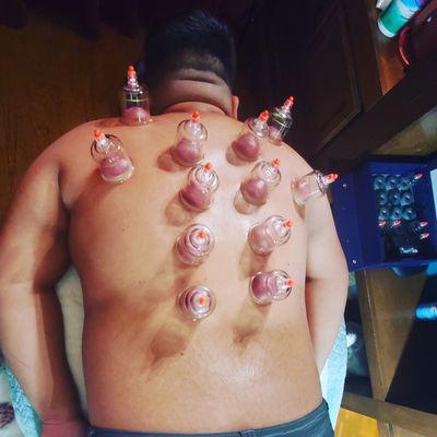 Cupping Therapy